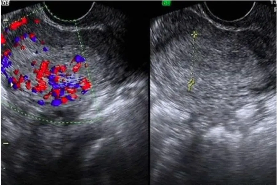 Siêu âm là cách chẩn đoán chính xác thai ngoài tử cung