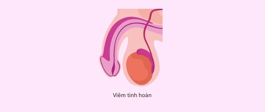 Quai bị có thể gây viêm tinh hoàn, một nguyên nhân ảnh hưởng đến khả năng sinh sản ở nam giới