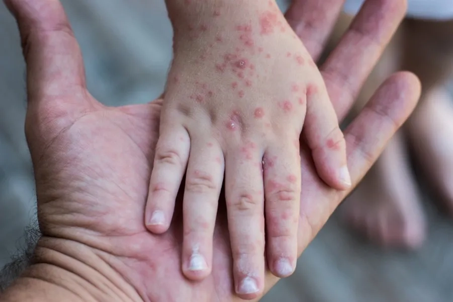 Nguyên nhân gây bệnh tay chân miệng do virus nên hoàn toàn có thể tái lại