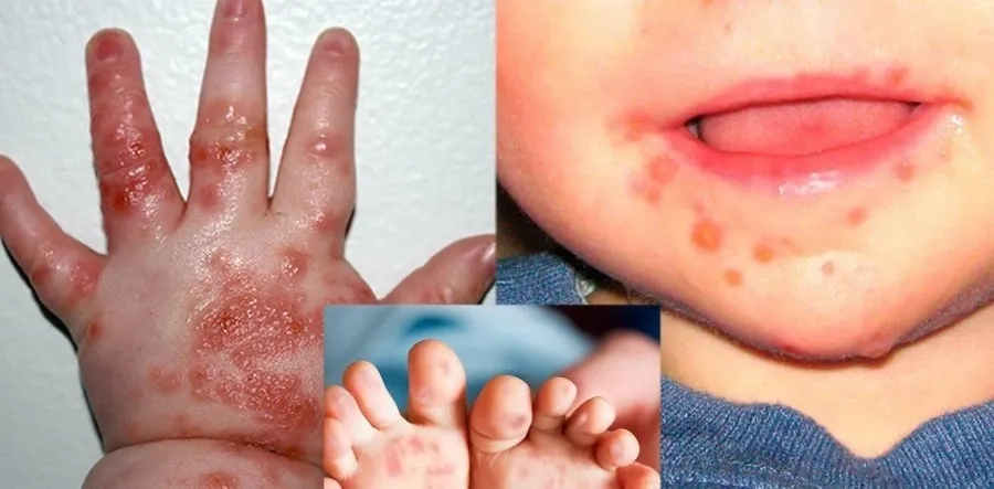 Khi da bị tổn thương nặng hoặc có dấu hiệu bội nhiễm, cần hoãn tắm và tham khảo ý kiến bác sĩ về cách vệ sinh phù hợp