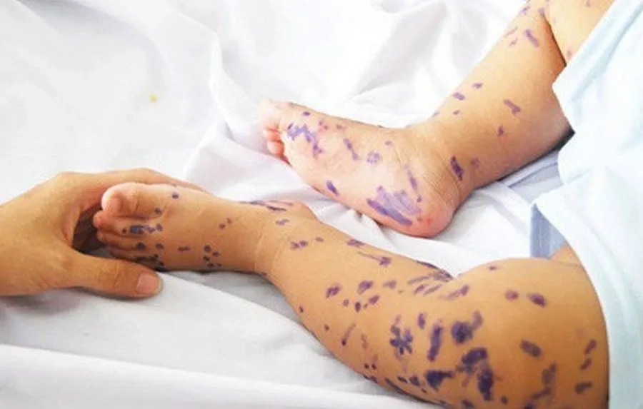 Các loại thuốc bôi cho trẻ tay chân miệng cần đúng theo chỉ dẫn