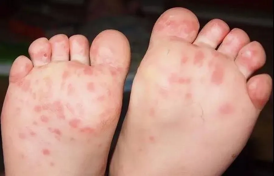 Trẻ bị tay chân miệng xuất hiện các bọng nước gây ngứa
