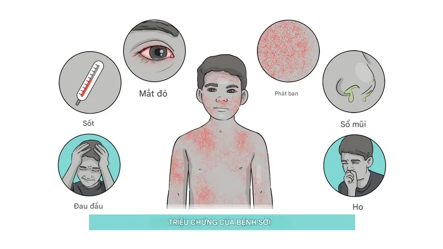 Biểu hiện thường gặp gồm sốt cao, ho, viêm kết mạc và phát ban lan toàn thân