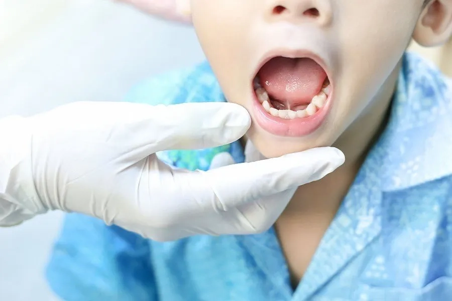 Trẻ bị dính thắng lưỡi độ 4 thường có thắng lưỡi ngắn và dày, khiến việc nâng lưỡi lên gặp nhiều khó khăn