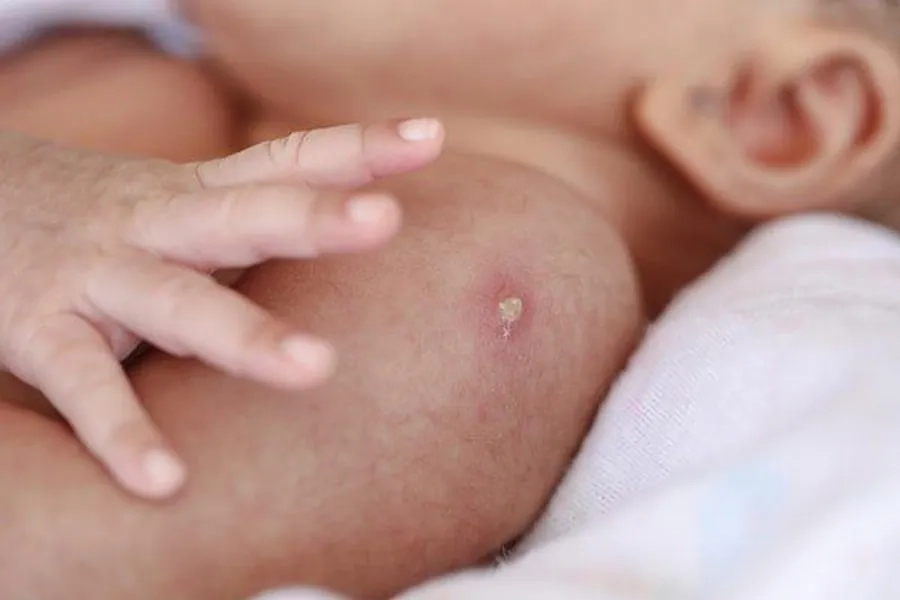 Phụ huynh nên theo dõi vết sưng đỏ sau tiêm ở trẻ nhỏ
