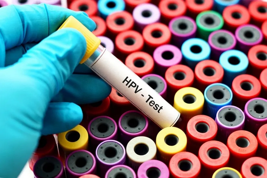 Xét nghiệm HPV giúp xác định type virus liên quan