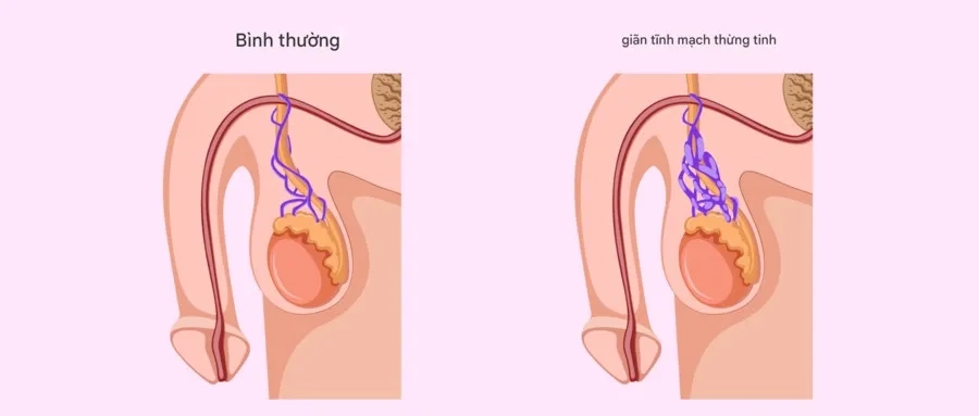 Giãn tĩnh mạch thừng tinh là một trong những nguyên nhân phổ biến gây vô sinh nam
