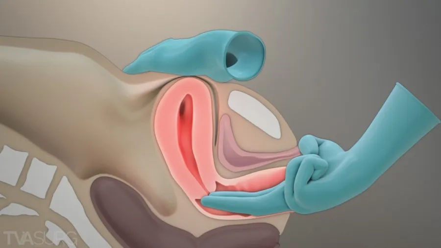 Kỹ thuật chuyên sâu được chỉ định trong một số trường hợp cần đánh giá chi tiết vùng chậu