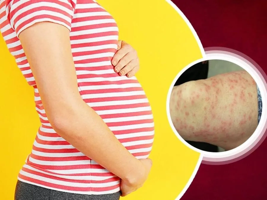 Sởi trong thai kỳ có thể ảnh hưởng đến cả mẹ và thai nhi