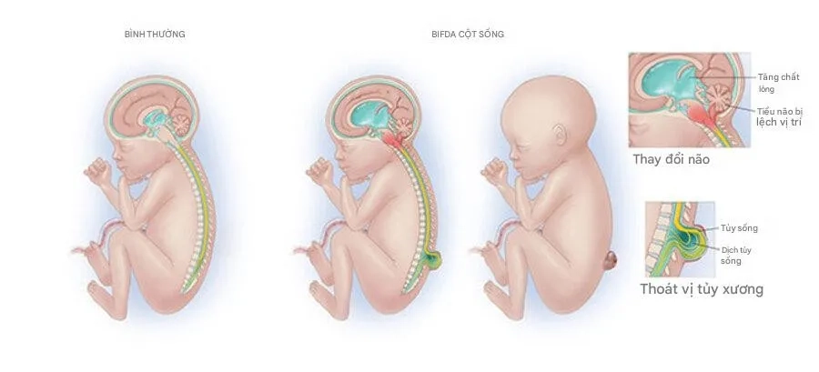 Nứt đốt sống là một dị tật bẩm sinh thuộc nhóm dị tật ống thần kinh, thường hình thành từ tuần thứ 3 - 4 của thai kỳ 
