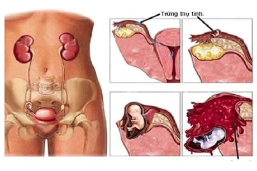 Thai ngoài tử cung khi vỡ có thể gây sốc do mất máu dẫn đến tử vong nếu không được phát hiện và can thiệp sớm