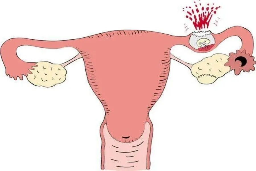 Khi kích thước thai ngoài tử cung phát triển có thể gây vỡ, nguy hiểm đến tính mạng