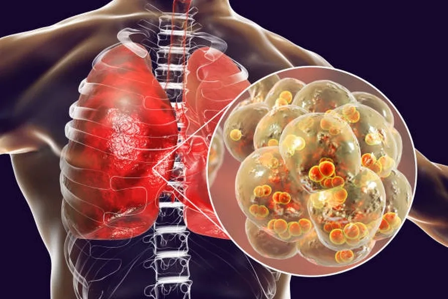 Vi khuẩn phế cầu là nguyên nhân hàng đầu dẫn đến viêm phổi
