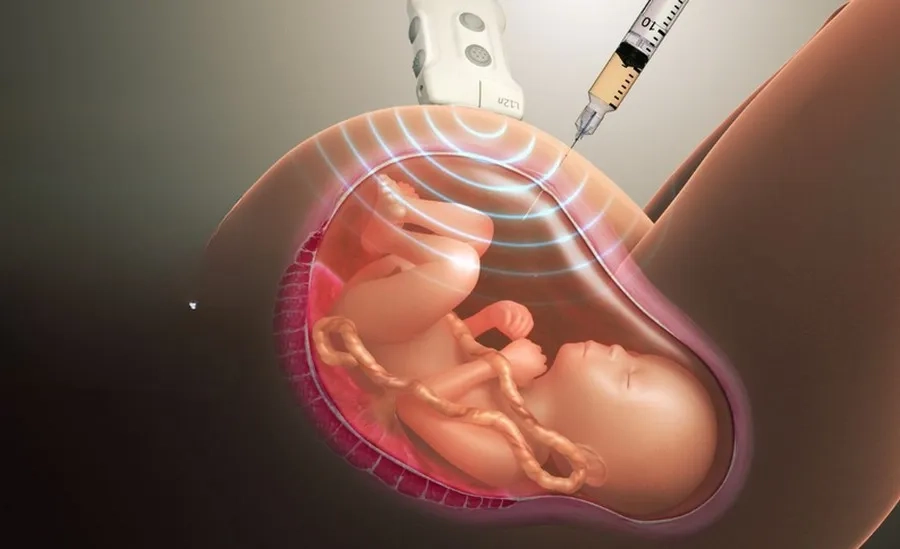 Phương pháp chọc hút ối giảm áp được áp dụng khi mẹ bầu gặp khó chịu nặng nề hoặc có nguy cơ sinh non cao