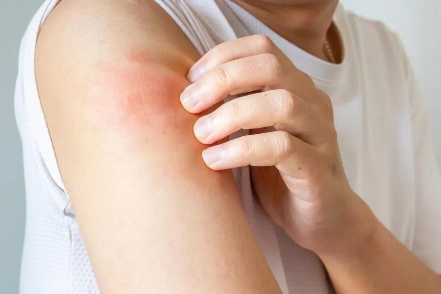 Hạn chế cào gãi giúp vùng phát ban hồi phục tốt hơn
