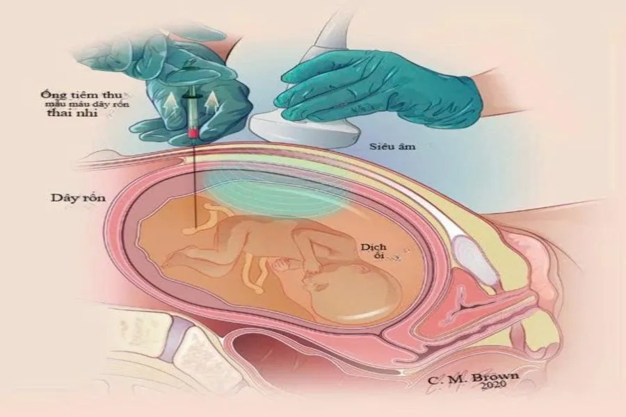Lấy máu cuống rốn là kỹ thuật thường được sử dụng để tìm ra nguyên nhân gây thai nhi bị thiếu máu 