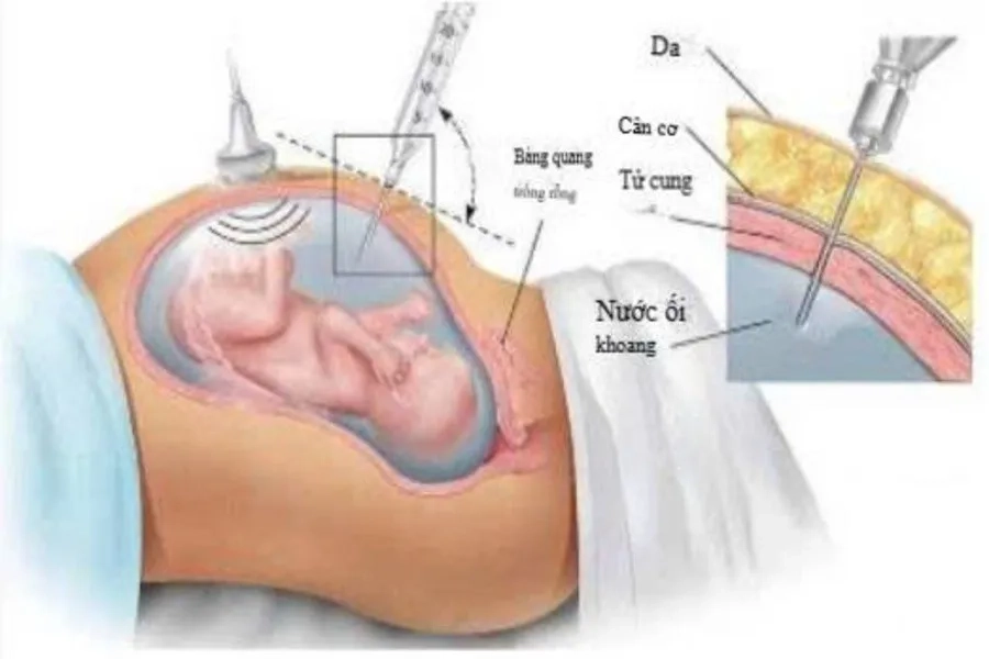 Chọc ối xác định nguyên nhân gây thiếu máu bào thai 
