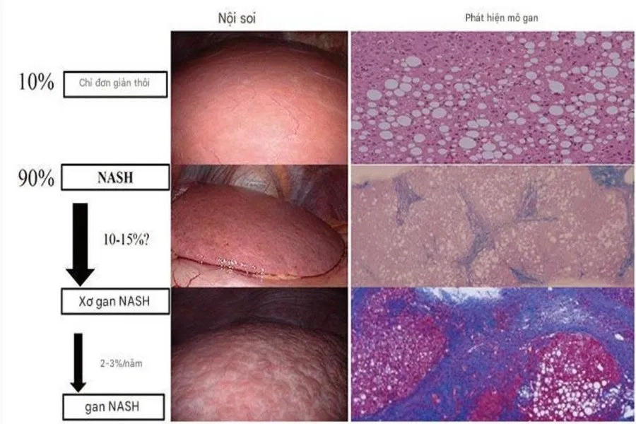 Phân biệt gan nhiễm mỡ và viêm gan NASH qua nội soi