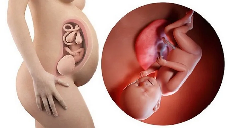 Đa ối nặng có thể ảnh hưởng đến quá trình chuyển dạ nguy hiểm cho mẹ và bé 