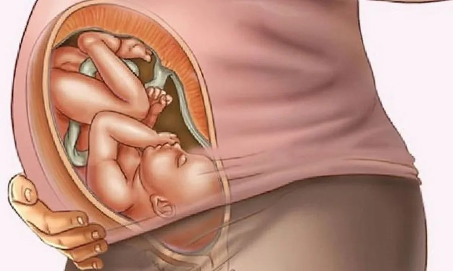 Đa ối ở tuần 32 có thể gây kích thích co bóp tử cung gây sinh non nếu không được theo dõi y tế