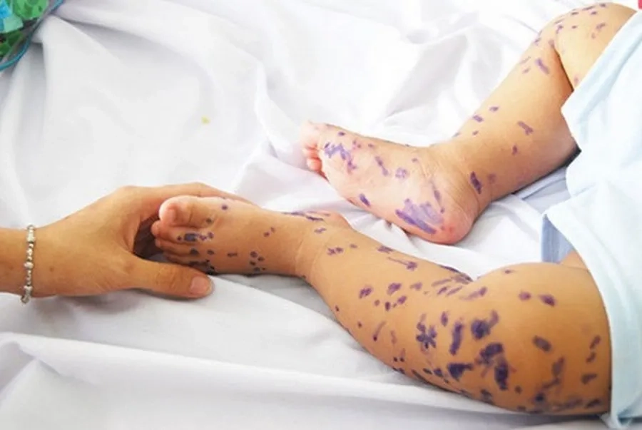 Thuốc bôi tay chân miệng cần dùng theo chỉ dẫn của bác sĩ chuyên khoa