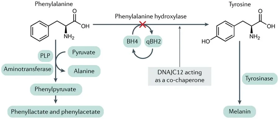 Phenylketon niệu (PKU) gây ảnh hưởng đến trí não của trẻ