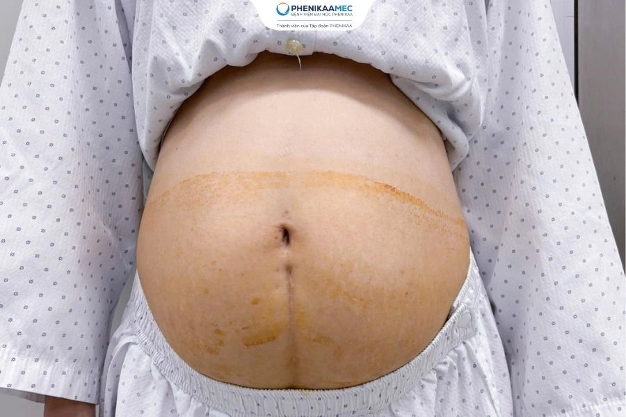 Lấy gọn khối u xơ tử cung gần 3,5 kg người bệnh 48 tuổi trút bỏ 