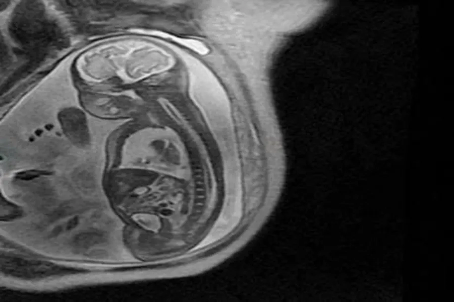 Chụp MRI cho thấy thai nhi bị tràn dịch màng phổi cần được hội chẩn chọc hút dịch màng phổi