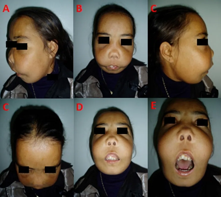 Hình ảnh bệnh nhân  tan máu bẩm sinh thalassemia thể nặng với các biểu hiện của tan máu và biến dạng xương do tăng sinh tủy xương: Vàng da vàng mắt, sạm da, xương gò má nổi, mũi tẹt, trán nhô, hàm trên nhô và thay đổi vị trí và góc của răng