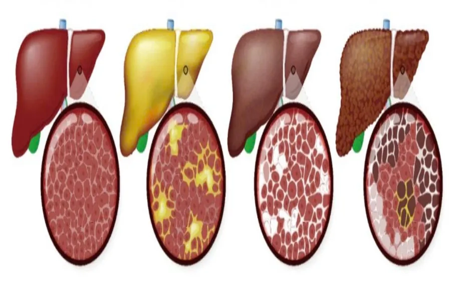 Lá gan khỏe mạnh và các phân độ gan nhiễm mỡ 1,2,3