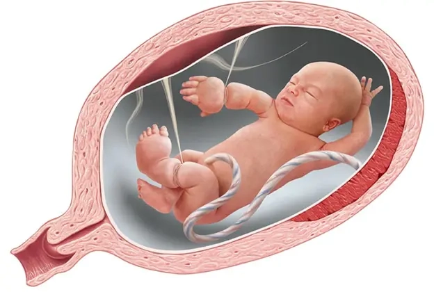 Hội chứng dải sợi ối là gì