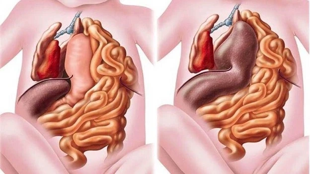 Thoát vị hoành thai nhi là gì?
