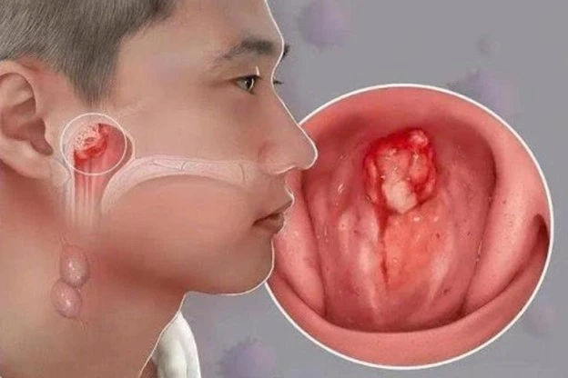 Vi rút HPV 16, 18 là nguyên nhân chính gây ung thư vòm họng 