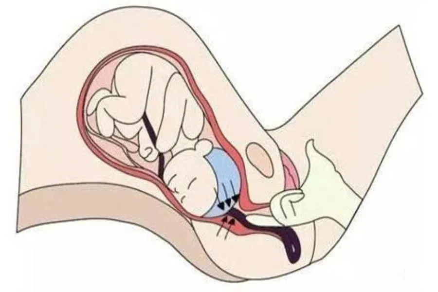 Vỡ ối có thể làm tăng nguy cơ sa dây rốn cần được theo dõi kịp thời 