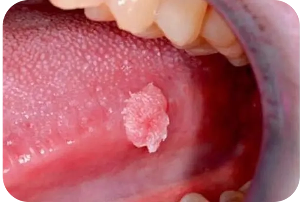 Nhiễm virus HPV có nguy hiểm không? 