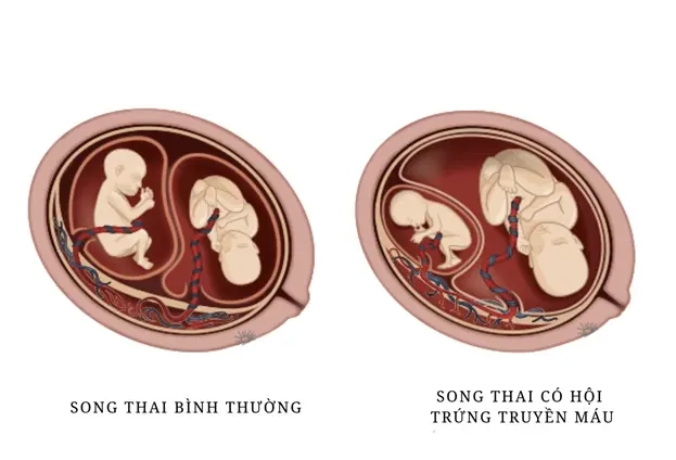Hội chứng truyền máu song thai là gì?