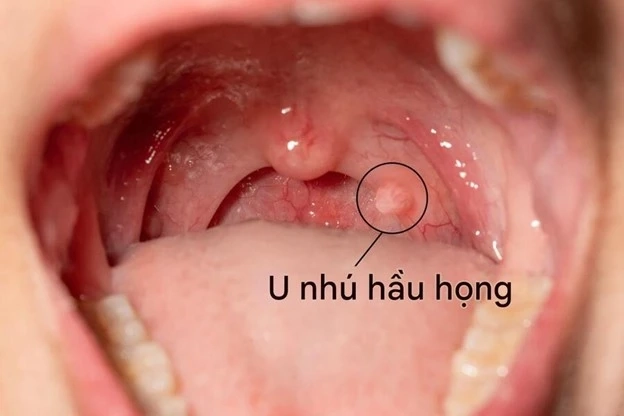 dấu hiệu nhiễm hpv