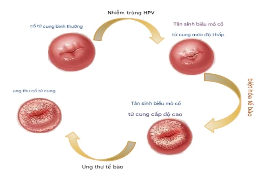 Ung thư cổ tử cung là căn bệnh hàng đầu do virus HPV gây nên 