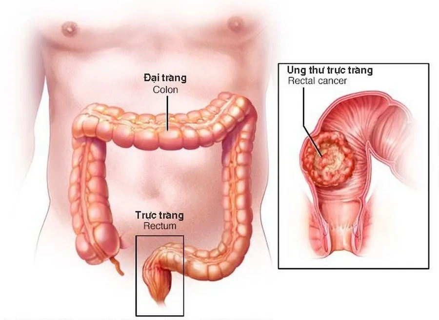 Nội soi đại - trực tràng phát hiện sớm ung thư 