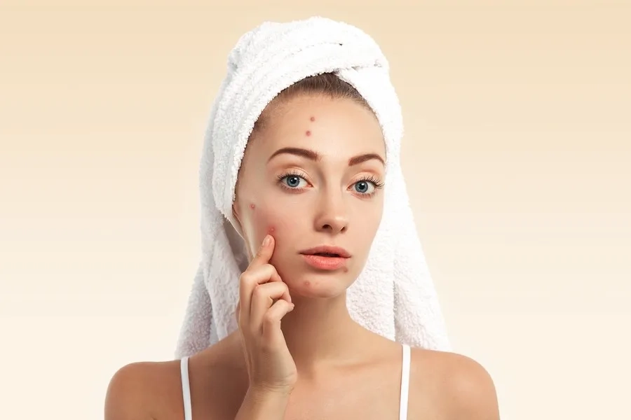 Nổi mụn kéo dài là dấu hiệu đa nang buồng trứng thường gặp