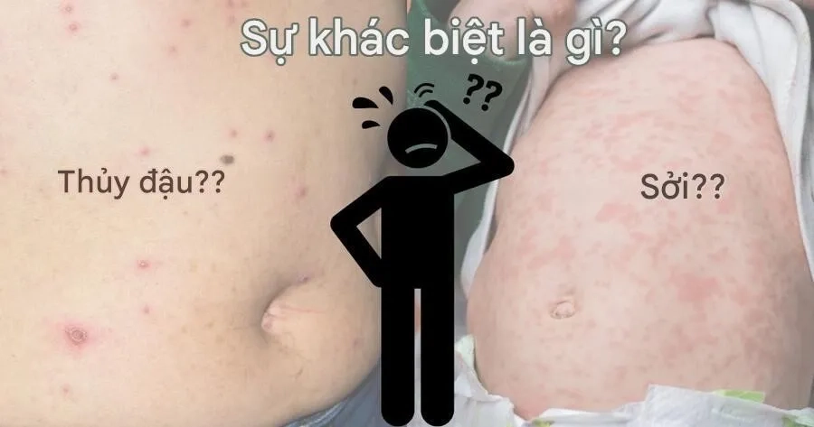 Ban sởi là các dát đỏ, còn thủy đậu đặc trưng bởi các mụn nước chứa dịch