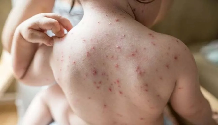 Thủy đậu đặc trưng bởi các mụn nước ngứa xuất hiện rải rác trên da