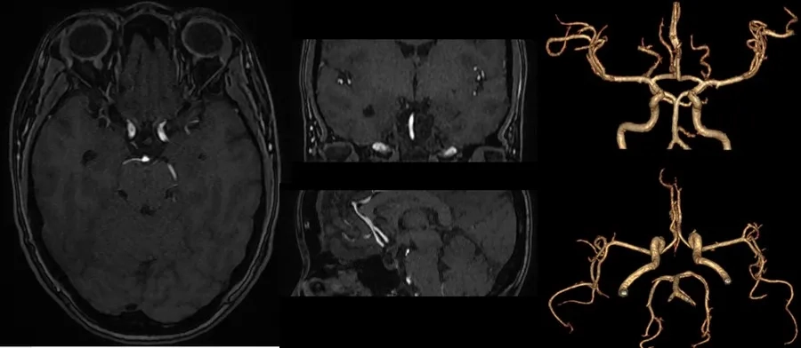Hình ảnh chụp MRI phình mạch máu não