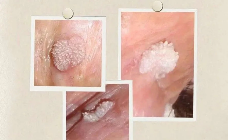 Sùi mào gà chủ yếu do virus HPV chủng 6 và 11 gây nên 
