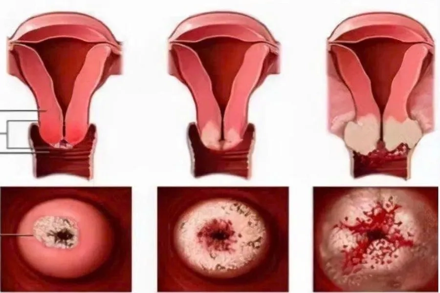 HPV được xác định là nguyên nhân gây nên 90% ca ung thư cổ tử cung