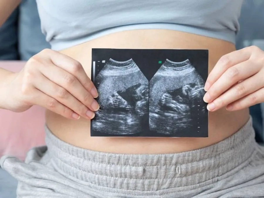 Sinh đôi là hiện tượng có 2 thai nhi cùng phát triển trong tử cung người mẹ