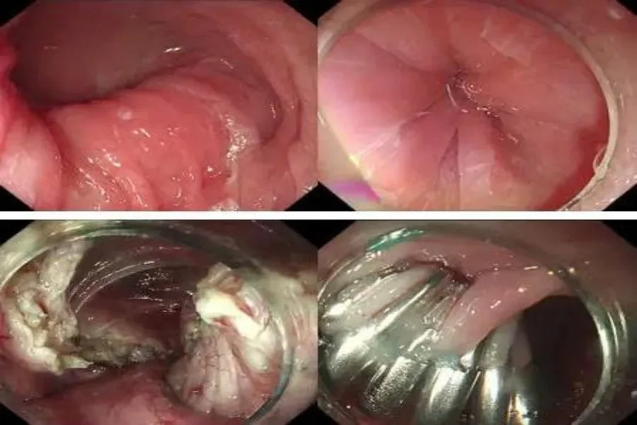 Phẫu thuật cắt cơ vòng thực quản giúp cải thiện tình trạng nuốt nghẹn 