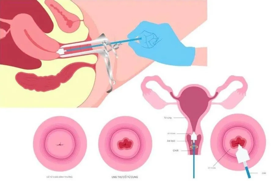 Sàng lọc ung thư cổ tử cung bằng xét nghiệm Pap smear