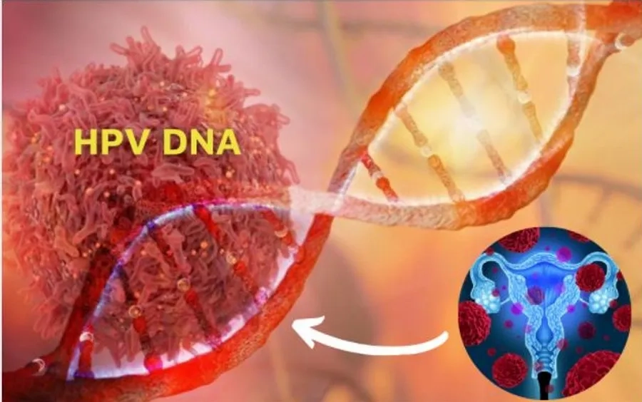 Xét nghiệm HPV DNA phát hiện các tuýp HPV có khả năng gây ung thư