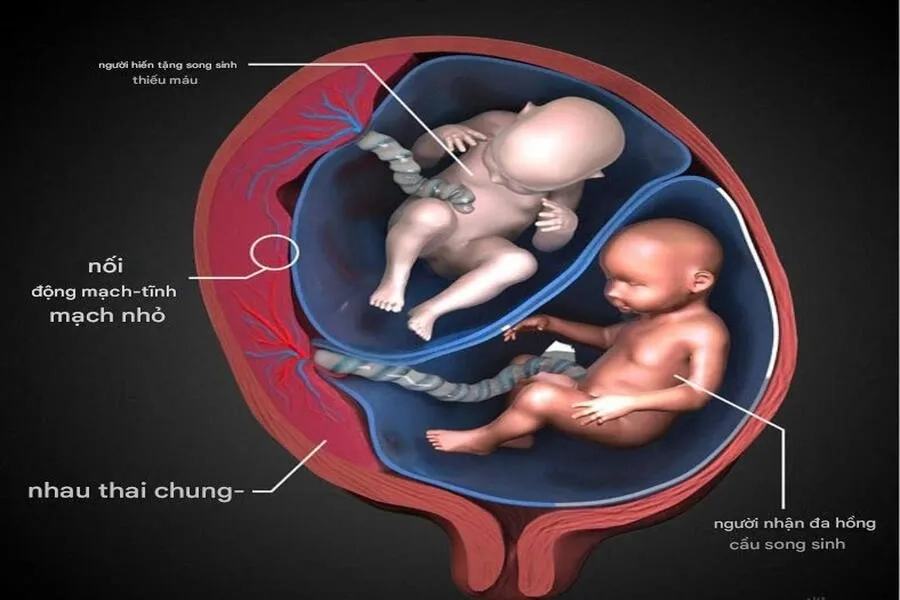 Thai nhi bị thiếu máu nặng có thể được chỉ định truyền máu cuống rốn